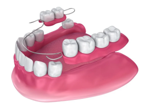 入れ歯はクラスプで歯に留められる