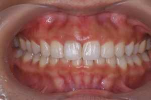 施術後の歯並び。歯列の改善と同時に写真左から3番目の黒ずんだ歯が白くなている